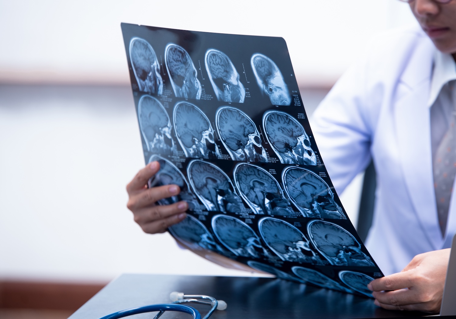 How Much Is a Traumatic Brain Injury Case Worth in San Diego?
