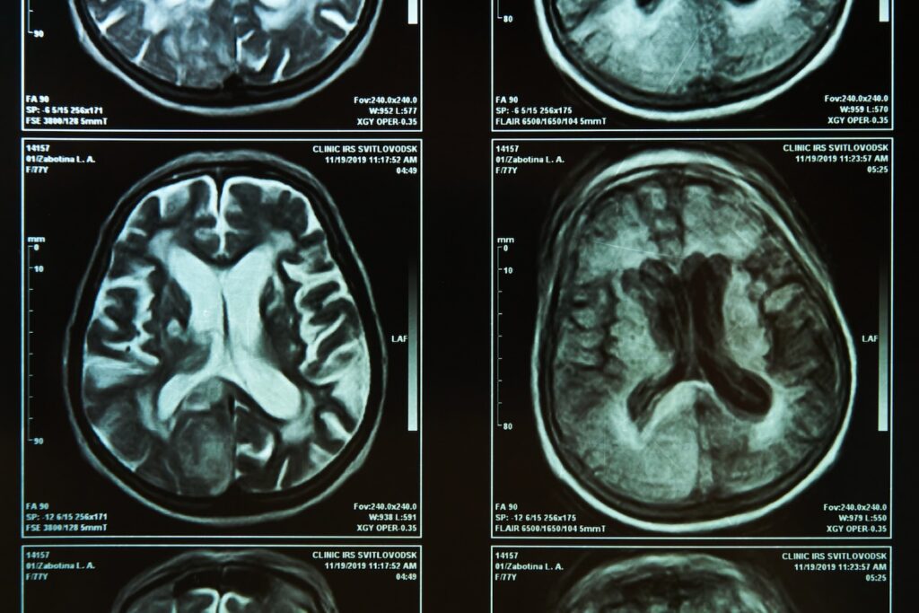 What Should I Do If a Family Member Has a Brain Injury?