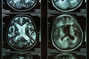 What Should I Do If a Family Member Has a Brain Injury?